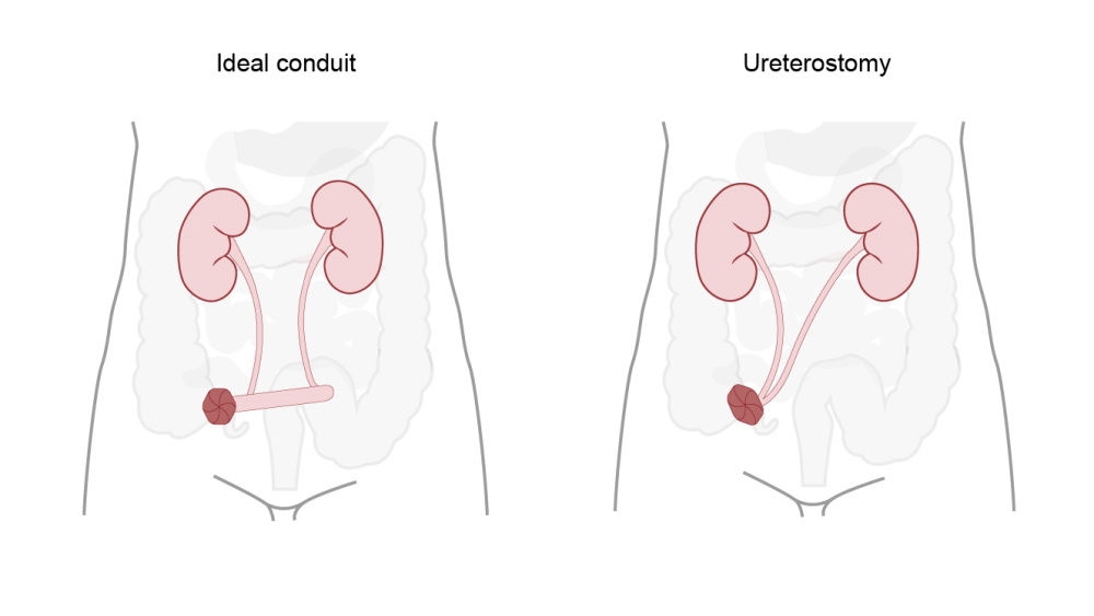 What is a Stoma? Stoma Function and Types Explained | B. Braun ...