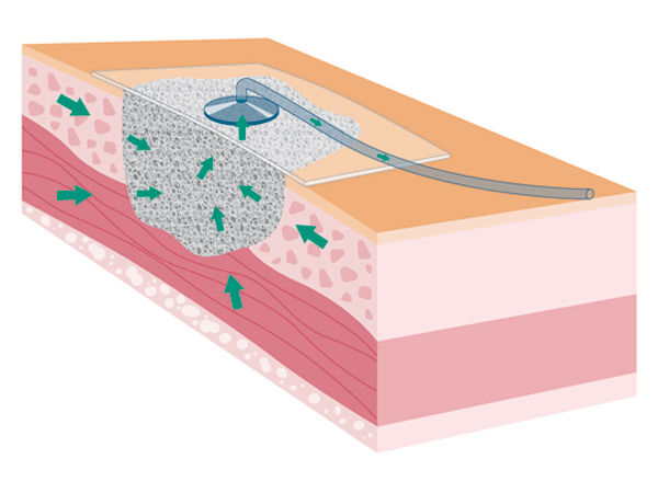 Illustration of the endoluminal vacuum therapy application