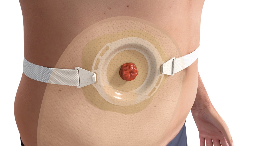 Stoma Inverting Convex Stoma Bags Against Stoma Leakages | B. Braun Australia - B. Braun