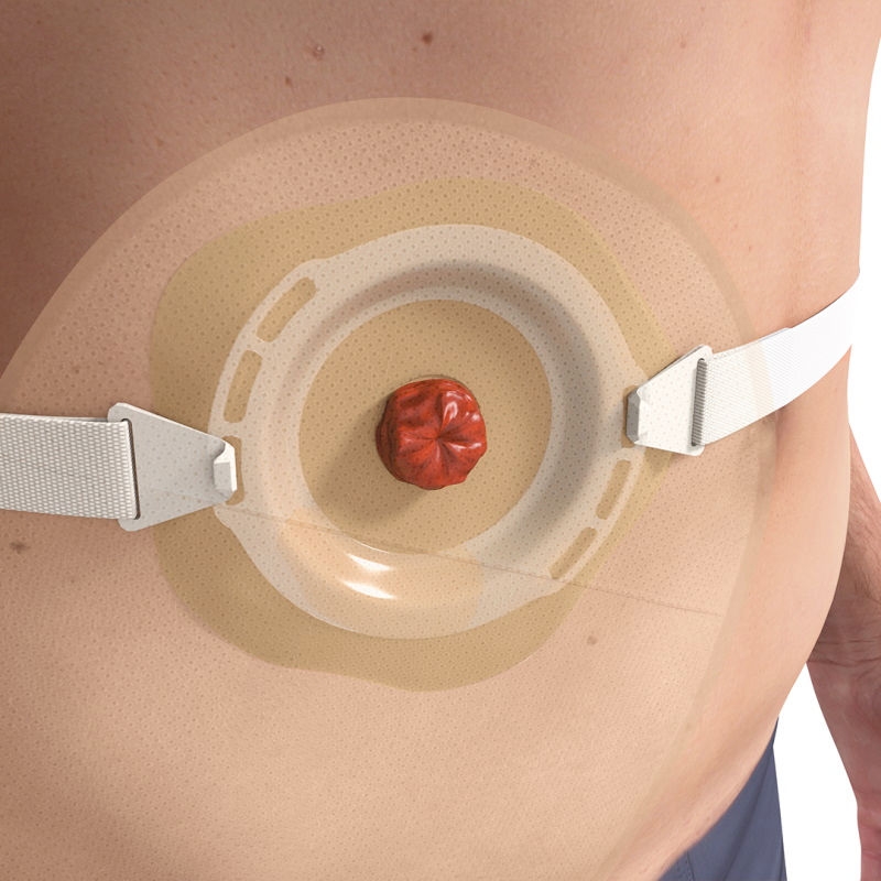 Flexima Active O' convex stoma bag one-piece system three slots