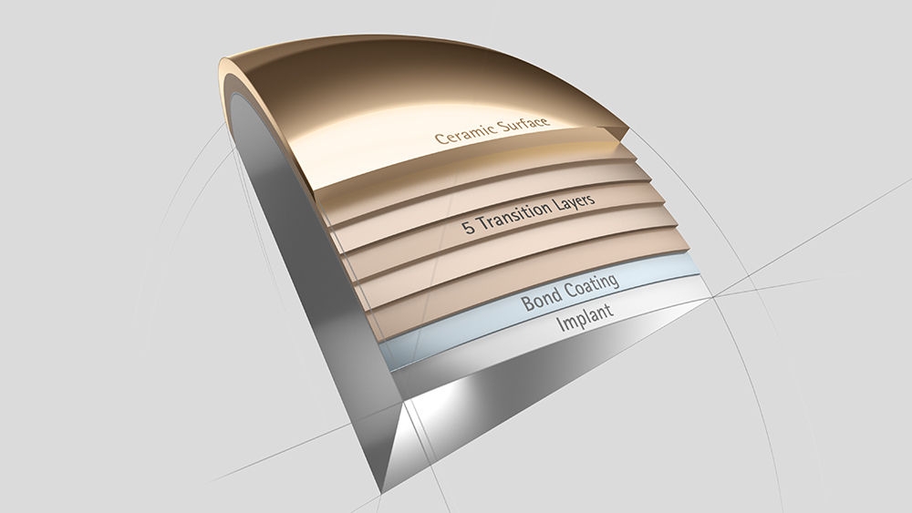 Knee implants with multilayer surface coating for allergic patients 