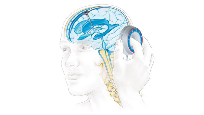 Graph of a brain with a hydocephalus shunt demonstration