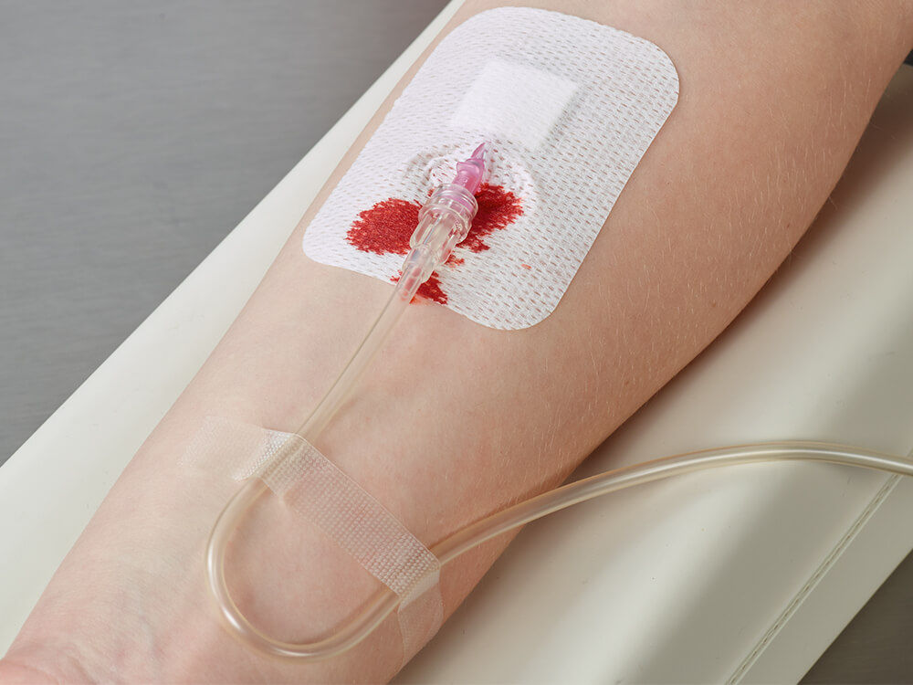 Blood spillage on IV dressing