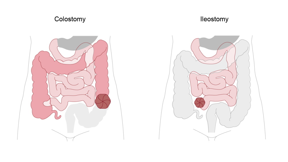 What is a Stoma? Stoma Function and Types Explained B. Braun