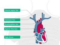 Misplacement and Malposition of Central Venous Catheters | B. Braun ...