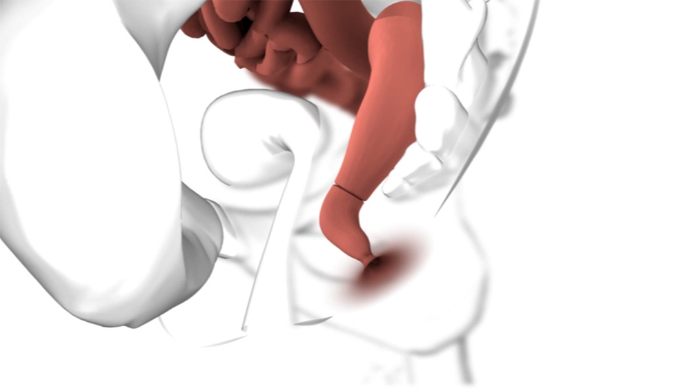 Animation about Endo-SPONGE® endoluminal vacuum therapy in the colorectal area