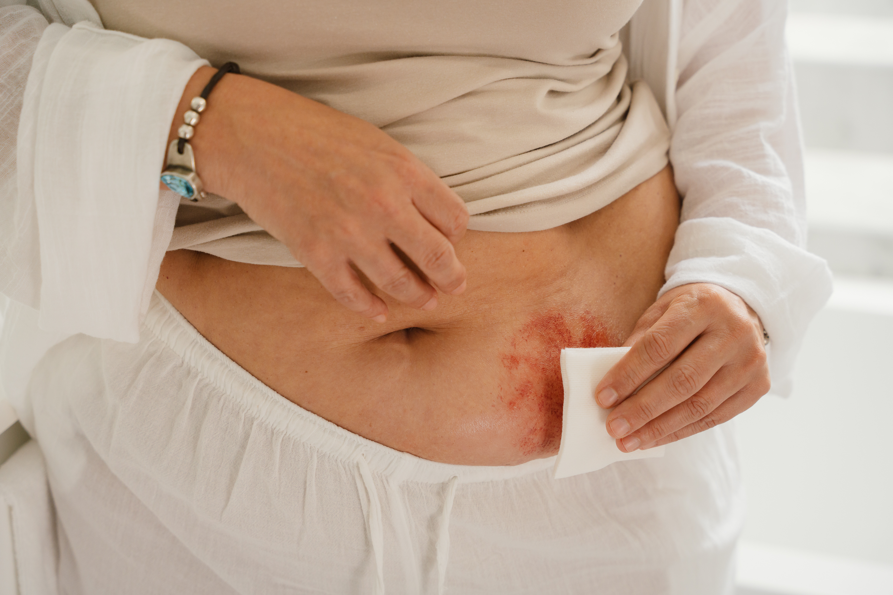 A close-up shot of a person with red skin irritation around the stoma, using a white medical gauze to gently clean  peristomal skin on their abdomen. The person is wearing light-colored clothing and a beaded bracelet on their wrist.