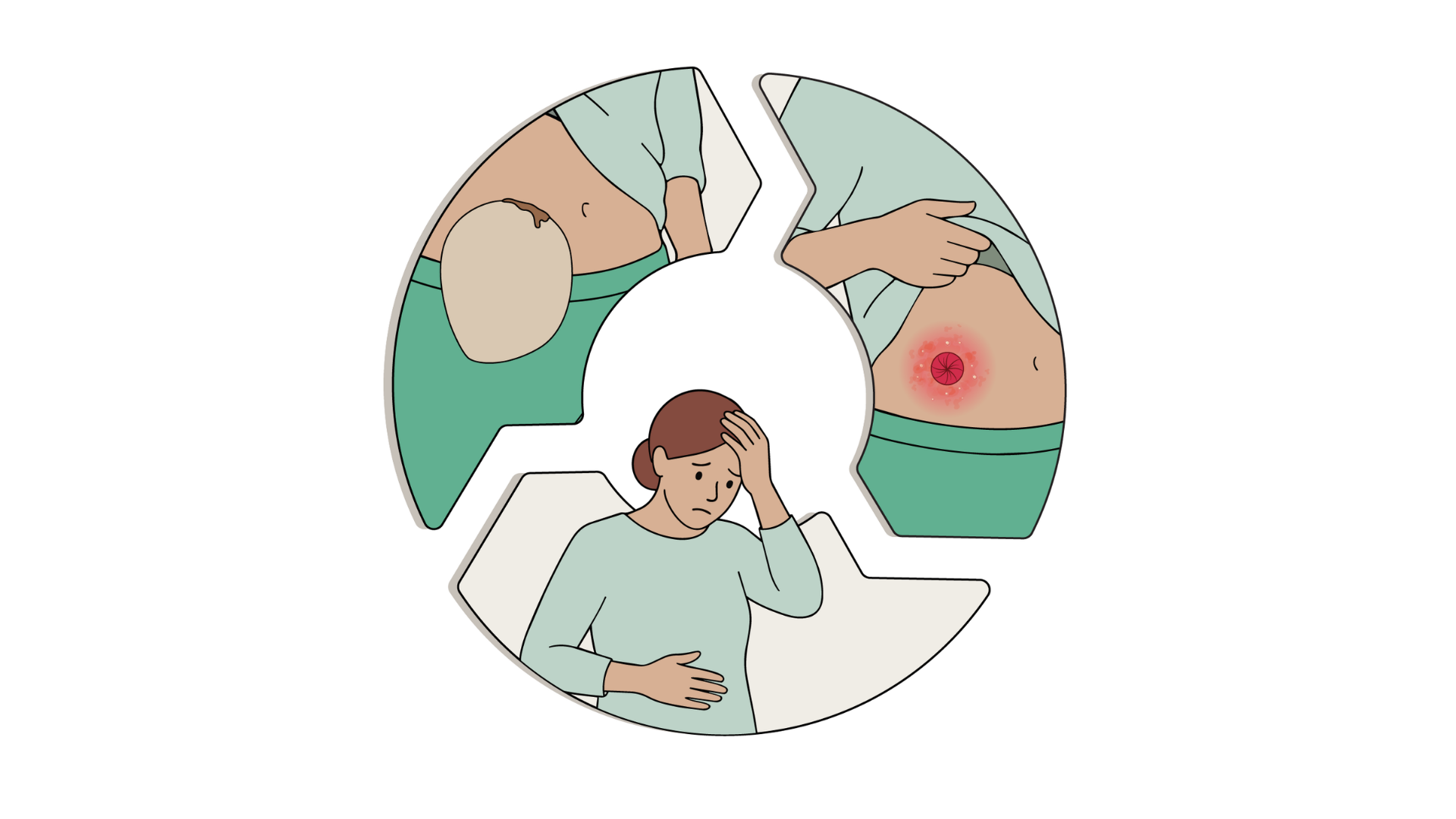 A circular diagram illustration showing the cycle of ostomy main complications: "Stoma Leakage" leading to "Skin Irritation," which results in a negative "Impact on Quality of Life," illustrated by a distressed woman.